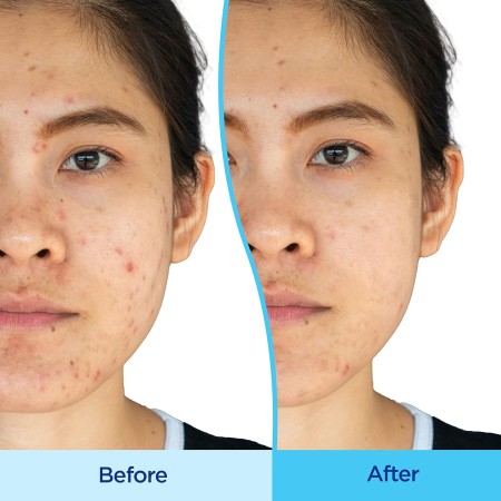 Differin Set de cuidado de la piel, régimen de 3 pasos de gel Differin Gel, tratamiento del acné, protector solar SPF 30 para